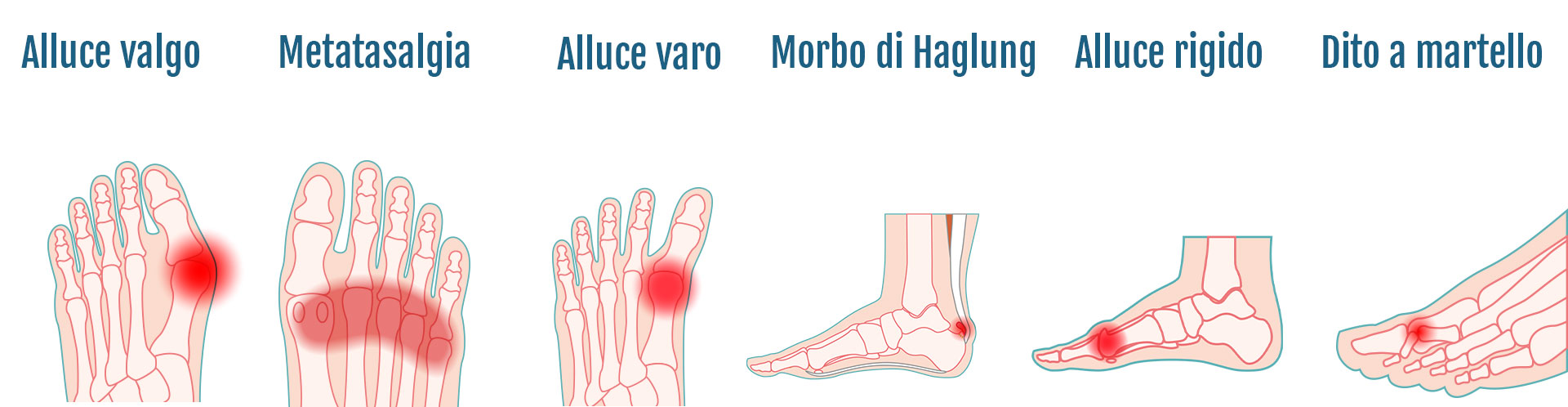forefoot pathologies